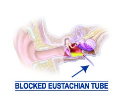 Eustachian tube_blocked